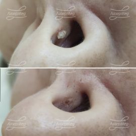 Лазерная деструкция вирусной бородавки (До и сразу После)