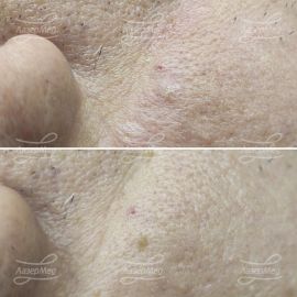 Лазерная деструкция кератом на лице (До и сразу После)