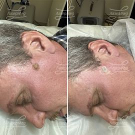 Удаление новообразования (До и сразу После)