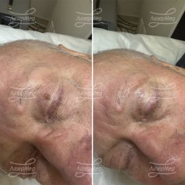 Удаление папилломы (До и сразу После)