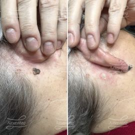 Удаление кератомы (До и сразу После)