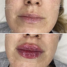 Контурная пластика губ