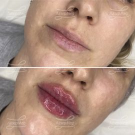 Контурная пластика губ
