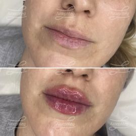 Контурная пластика губ