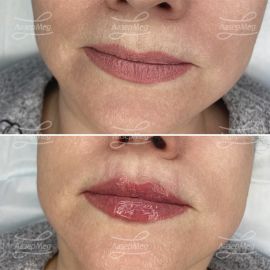 Контурная пластика губ