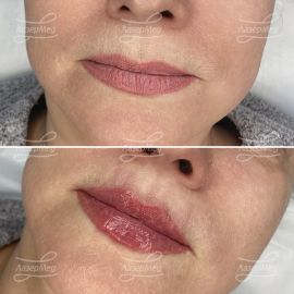 Контурная пластика губ