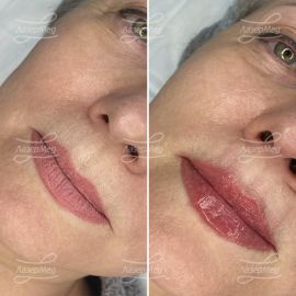 Контурная пластика губ