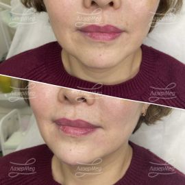 Коррекция подбородка