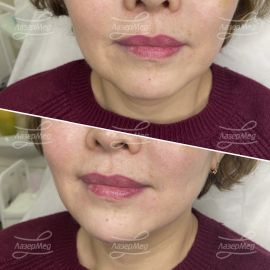 Коррекция подбородка