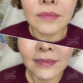 Коррекция подбородка