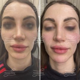 Контурная пластика подбородка и скул