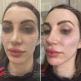 Контурная пластика подбородка и скул