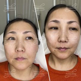 Контурная пластика скул