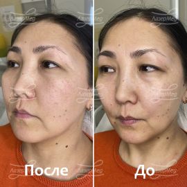 Контурная пластика скул