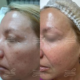 Лазерное удаление сосудов и пигментных пятен, биоревитализация, Релатокс (ботокс), пилинг