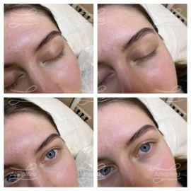 Удаление папилломы (До и сразу После)