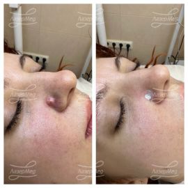 Удаление родинки (До и сразу После)