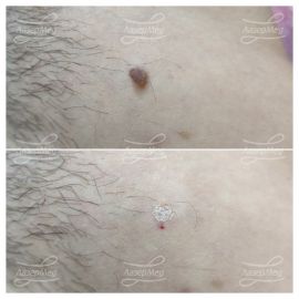 Лазерная деструкция невусов (До и сразу После)