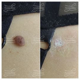Лазерная деструкция невусов (До и сразу После)