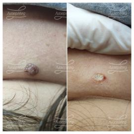 Лазерная деструкция невусов (До и сразу После)