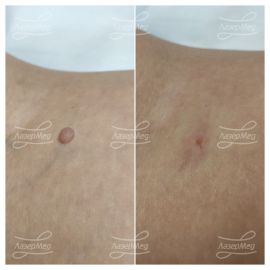 Лазерная деструкция невусов (До и сразу После)