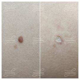 Лазерная деструкция невусов (До и сразу После)