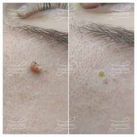 Лазерная деструкция кожного рога (До и сразу После)