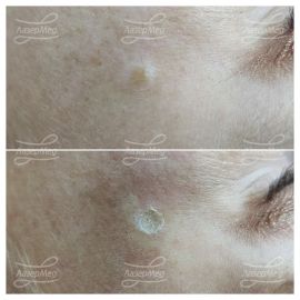 Лазерная деструкция невусов (До и сразу После)