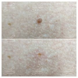 Лазерная деструкция невусов (До и сразу После)