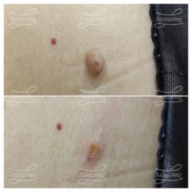 Лазерная деструкция фибромы (До и сразу После)