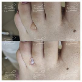 Лазерная деструкция вирусной бородавки (До и сразу После)