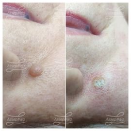 Лазерная деструкция невусов (До и сразу После)