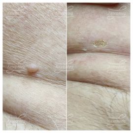 Лазерная деструкция невусов (До и сразу После)