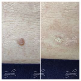 Лазерная деструкция невусов (До и сразу После)