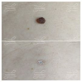 Лазерная деструкция невусов (До и сразу После)