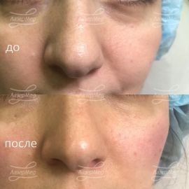 Коррекция дефицита объема в области скуловой дуги