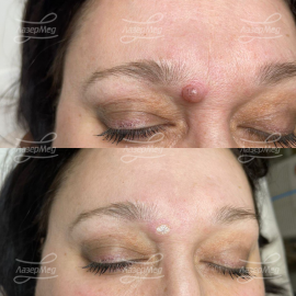 Лазерная деструкция невусов (До и сразу После)