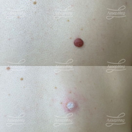 Лазерная деструкция невусов (До и сразу После)