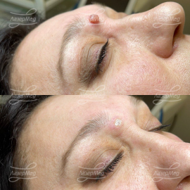 Лазерная деструкция невусов (До и сразу После)