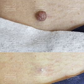 Лазерная деструкция невусов (До и сразу После)