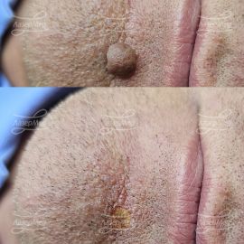 Лазерная деструкция невусов (До и сразу После)