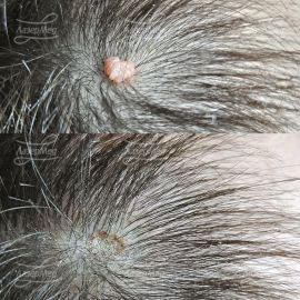 Лазерная деструкция невусов (До и сразу После)