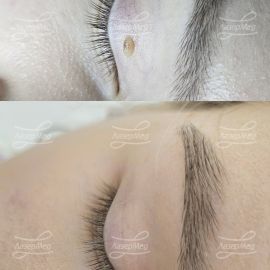 Лазерная деструкция невусов (До и сразу После)