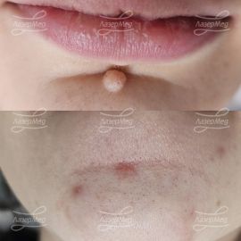 Лазерная деструкция невусов (До и сразу После)