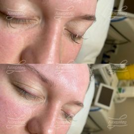 Папиллома в области ресничного края