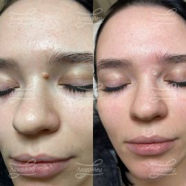 Лазерная деструкция невусов (До и сразу После)