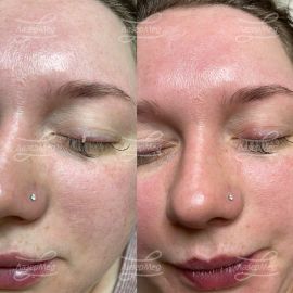 Родинка (невус)