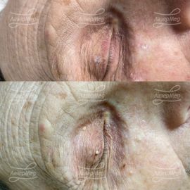 Паппилломы и миллиум