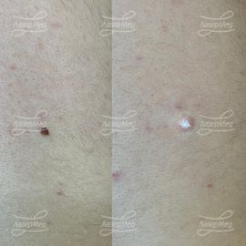 Родинка (невус)