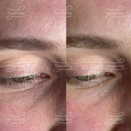 Папиллома в области ресничного края